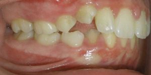 Thumb Sucking: Break the Unhealthy Dental Habit